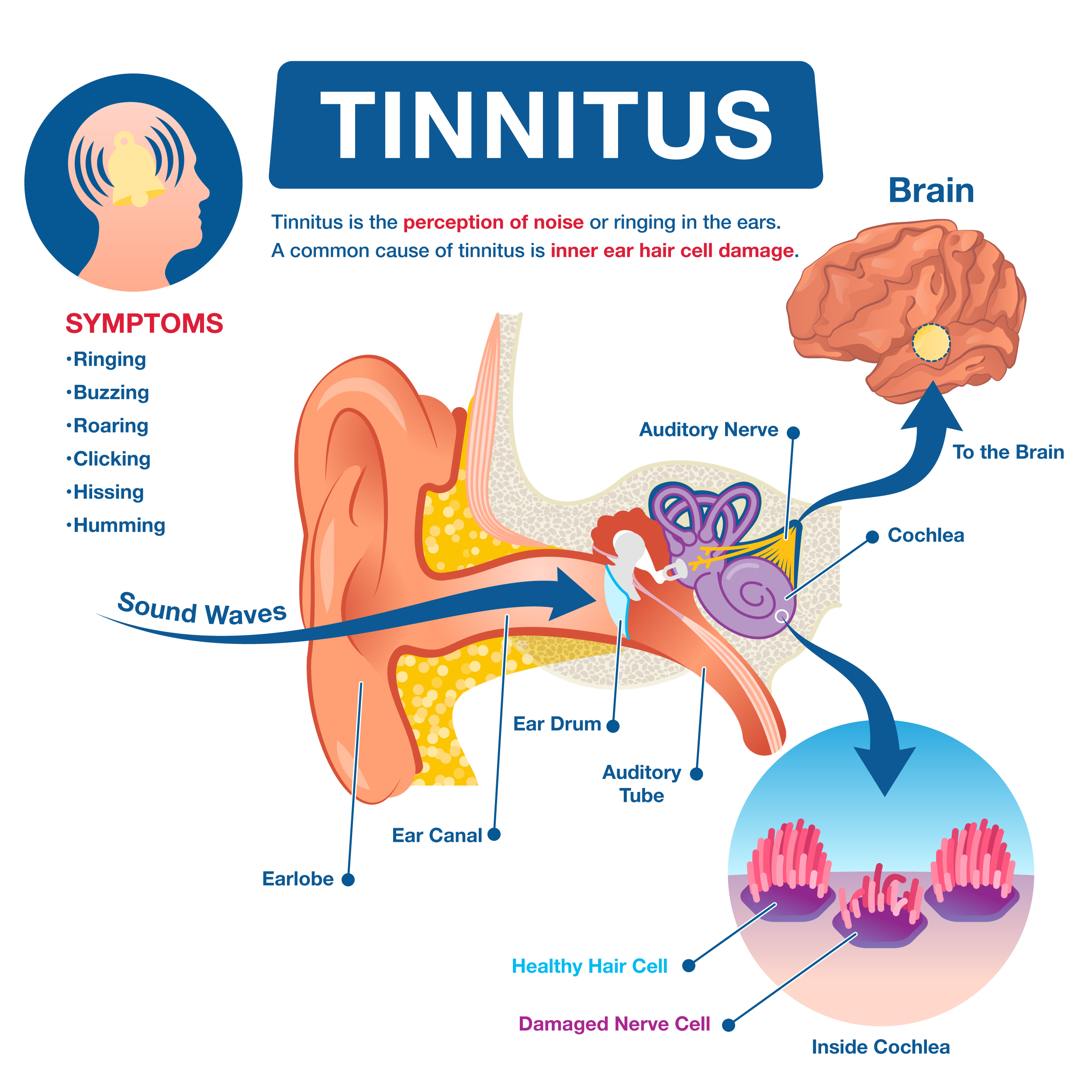 Tinnitus